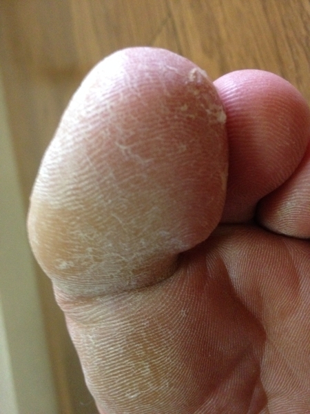治療２日目　左足の親指２