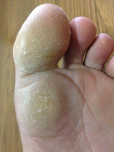 治療３日目　左足の親指