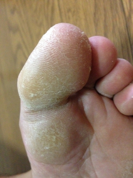 治療３日目　左足の親指の先端