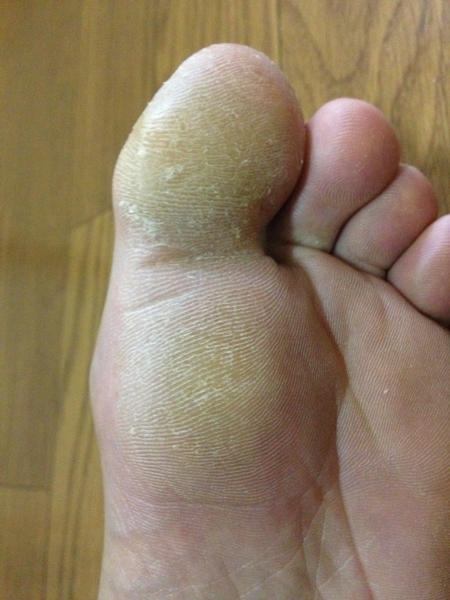 治療４日目　左足の親指